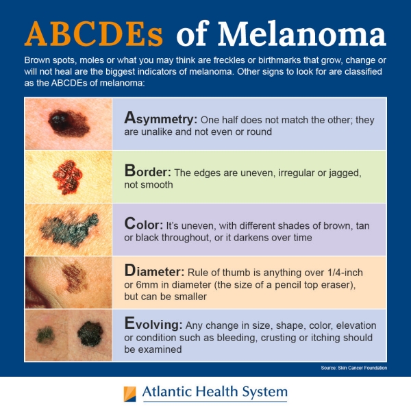 How to Spot Melanoma: The Early Warning Signs of Skin Cancer