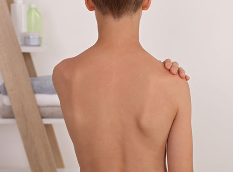 Backview of a teenager showing scoliosis of the spine