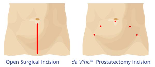 3_Incision_Comparison_Prostatectomy_gl600w.jpg